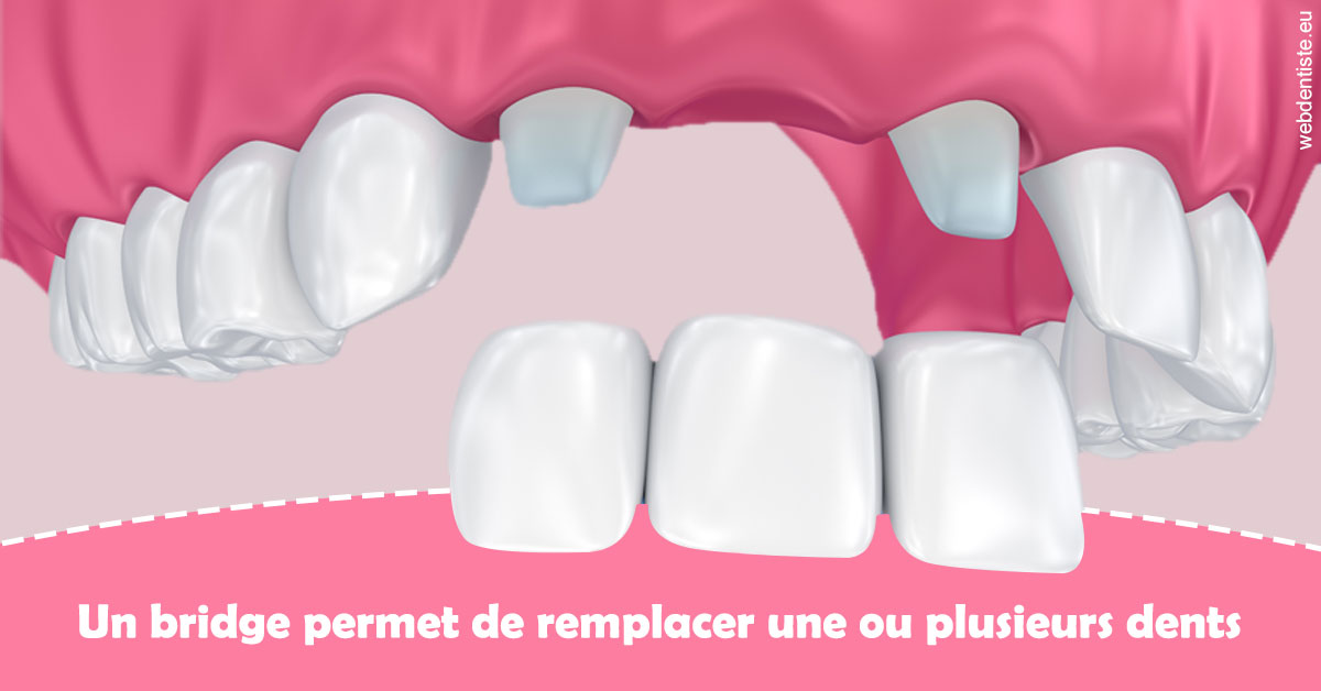 https://docteur-dabert-laurent-anne-gaelle.chirurgiens-dentistes.fr/Bridge remplacer dents 2
